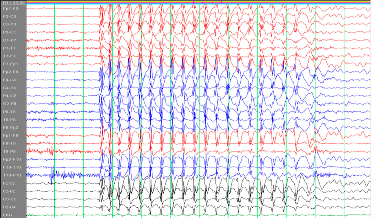 Figur 1 EEG fra et barn med en absens
