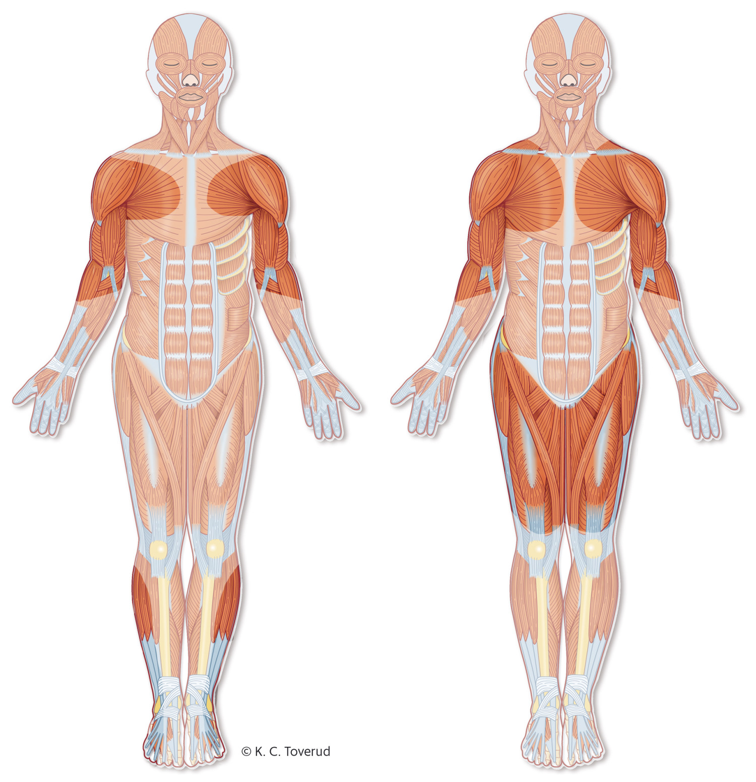Figur 1  Typisk distribusjon av muskelsvakhet ved Emery-Dreifuss' muskeldystrofi (til venstre) og skulder-hofte&hellip;