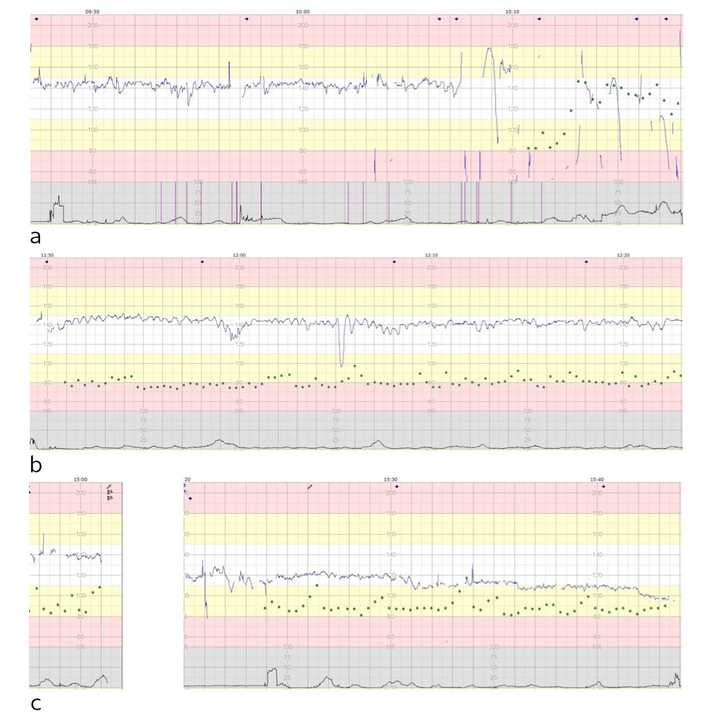 Figur 2 Kardiotokografi (CTG) med fosterhjertefrekvens (bl&aring; linje), riregistrering (svart linje), mors puls (gr&oslash;nne sirkler)&hellip;