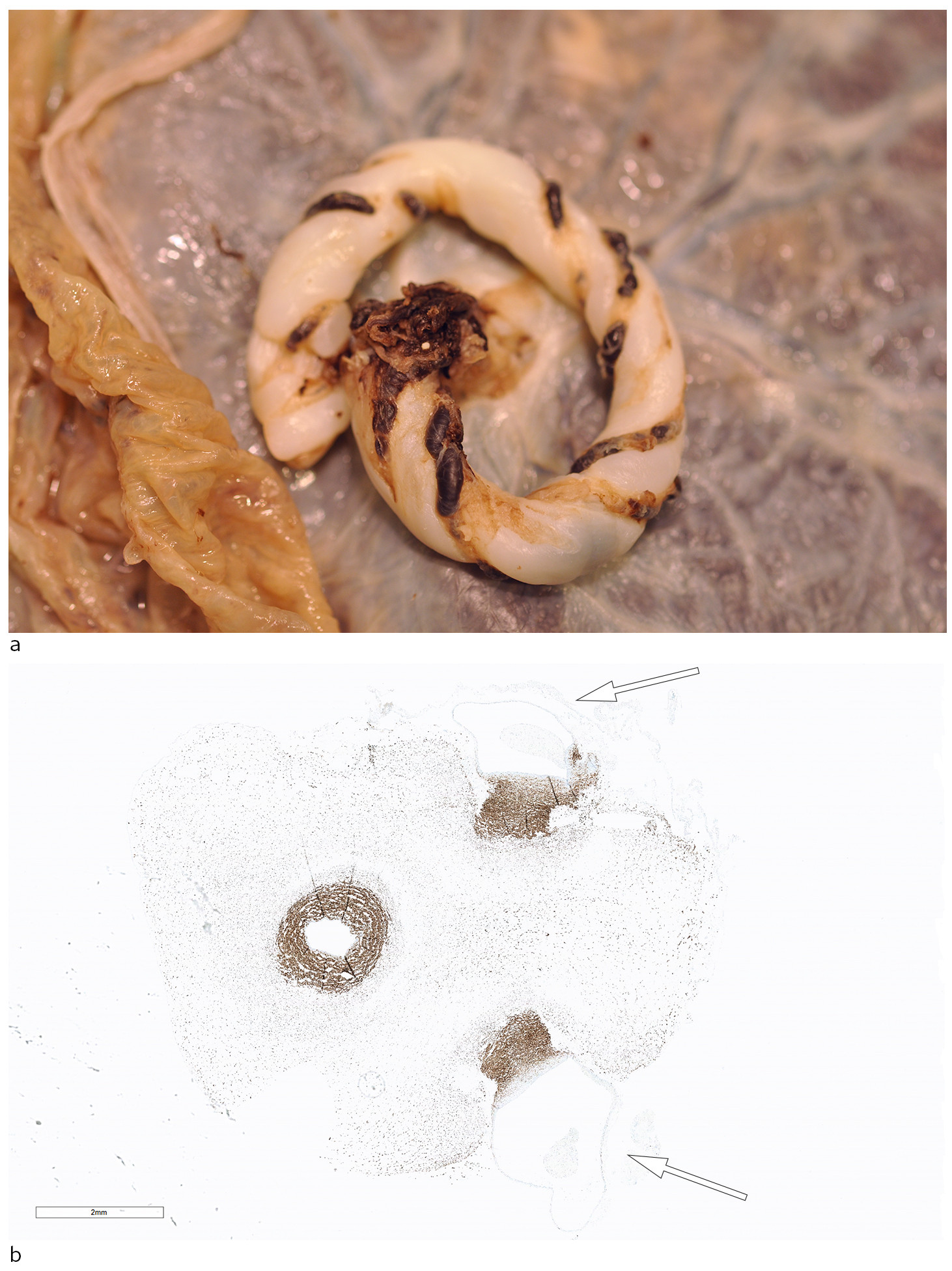 Figur 4 a) Snoren etter formalinfiksering. b) Tverrsnitt fra snor farget med muskelmark&oslash;ren desmin. Her ses tydelig&hellip;
