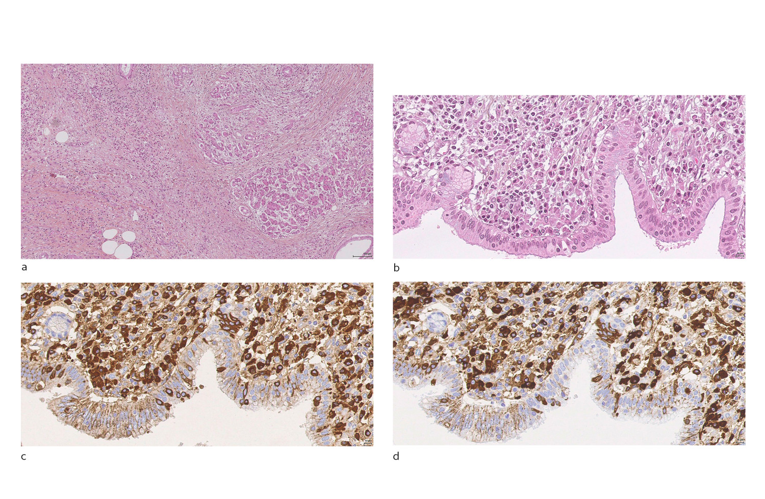 Figur 1 Histologi fra pasient med IgG4-relatert sykdom med pancreasaffeksjon. a) Snitt fra pancreas. Hematoksylin- og&hellip;