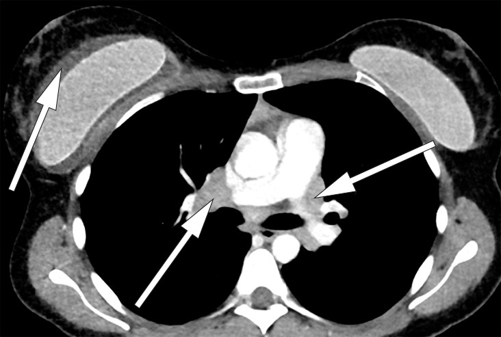 Figur 1 CT thorax med intraven&oslash;s kontrast, sagittalsnitt. I h&oslash;yre hilus ses lymfeknutekonglomerat som m&aring;ler 3 cm&hellip;