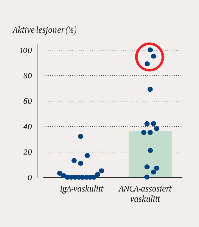 Figur 2 Prosentandel glomeruli med aktive lesjoner (halvm&aring;ner/nekroser). Hvert punkt representerer en biopsi fra en pasient,&hellip;