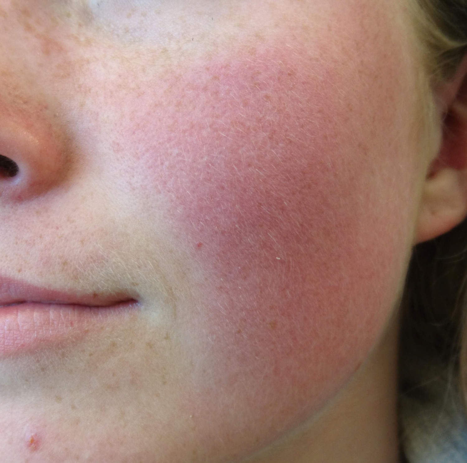 Figur 1 Erytemat&oslash;s teleangiektatisk rosacea