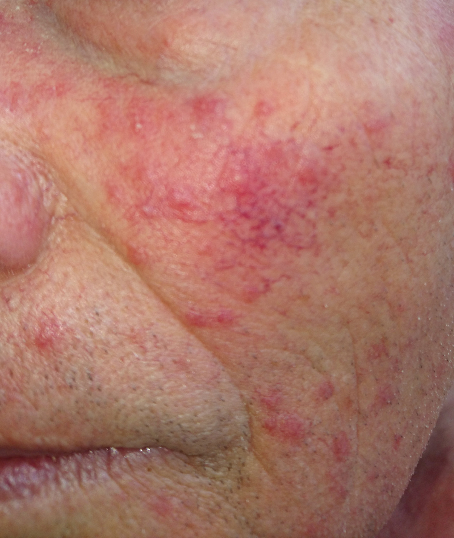 Figur 2 Papulopustul&oslash;s rosacea