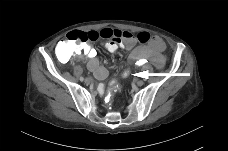 Figur 1 CT abdomen. Veggfortykket tynntarmssegment (pil) med fettvevsinfiltrasjon og markerte lymfeknuter i mesenteriet