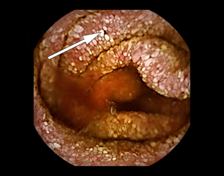Figur 3 Kapselendoskopi (PillCam, SB 3). Tynntarmssegment med uttalt lymfangiektasi og &oslash;demat&oslash;se totter