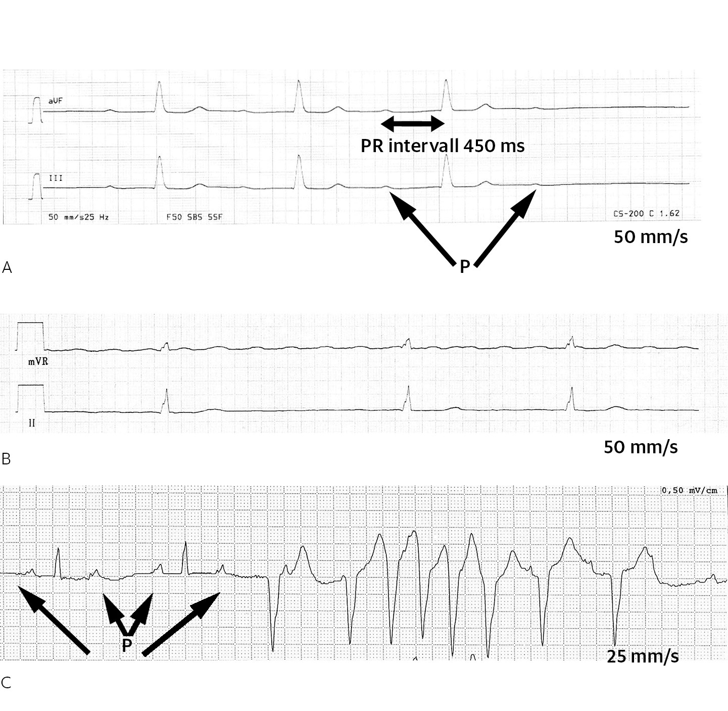 Figur 2 Triade av atrioventrikul&aelig;rt (AV) blokk, atrieflimmer og ventrikul&aelig;r takykardi (VT), her fremstilt fra tre ulike LMNA&hellip;