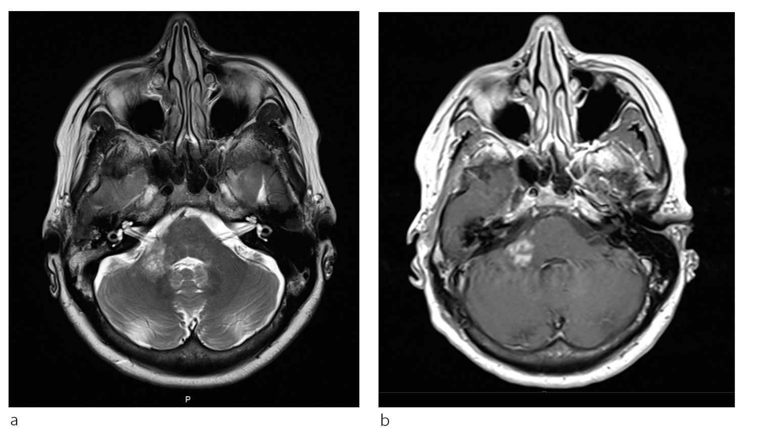 Figur 2 a) Det T2-vektede bildet viser en inhomogen h&oslash;yattenuerende forandring i h&oslash;yre lillehjernestilk som ikke er lett &aring;&hellip;