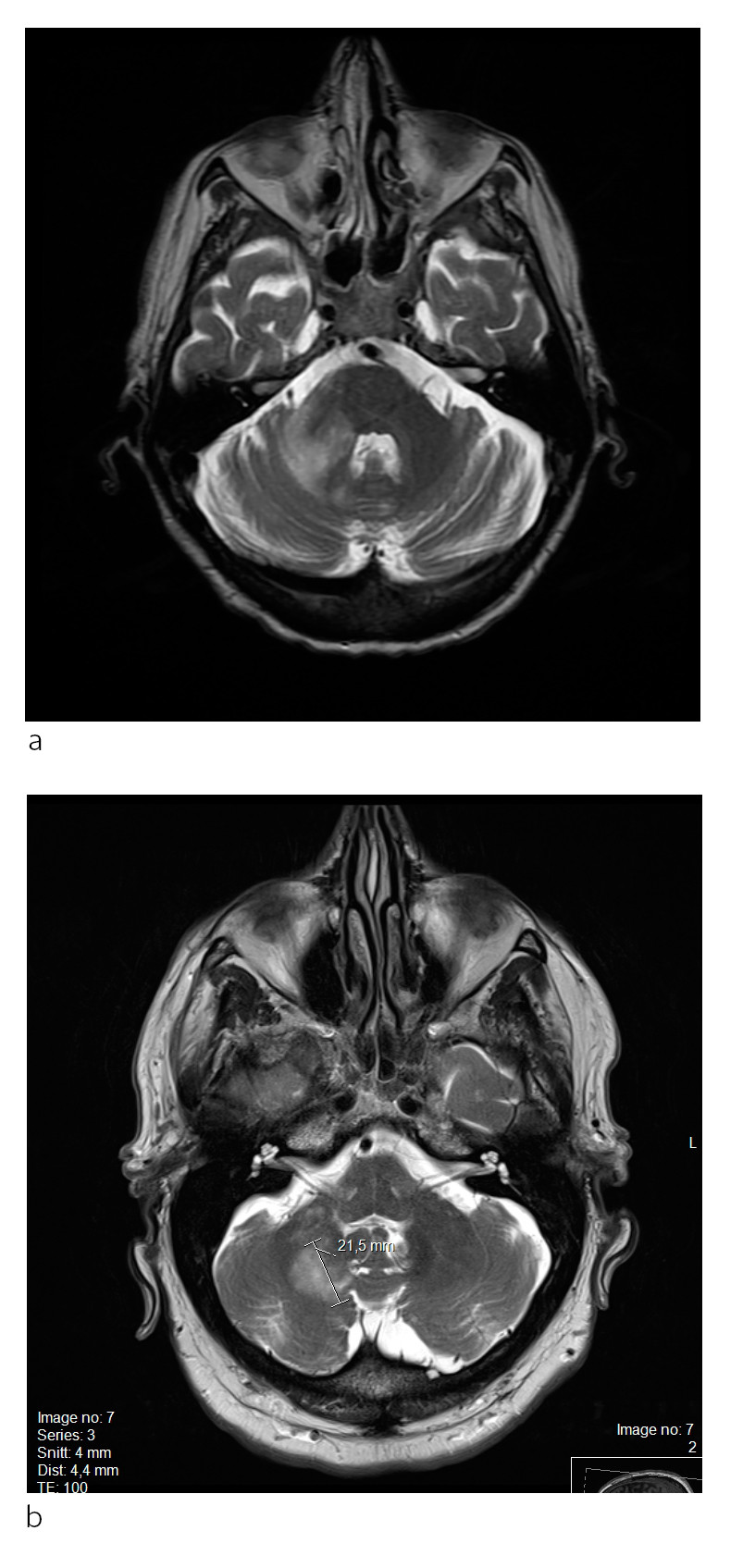 Figur 3 a) T2-vektet MR-bilde viser halvm&aring;neformet h&oslash;ysignalforandring i h&oslash;yre cerebell&aelig;rhemisf&aelig;re og i &oslash;vre cerebell&aelig;re&hellip;