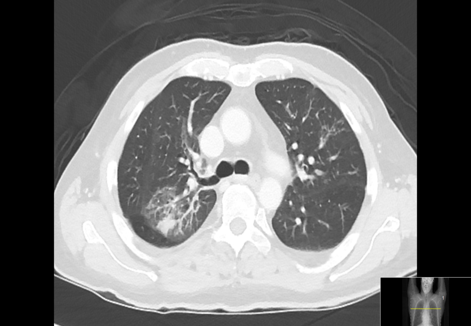 Figur 2 CT thorax, transversalplan, hvor man i h&oslash;yre overlapp ser en konsolidert fortetning med mattglassforandringer i&hellip;