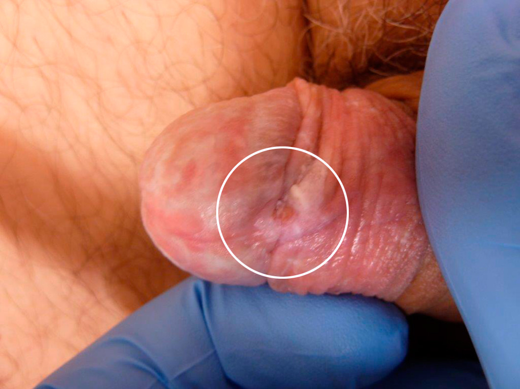 Fig 1 S&aring;r p&aring; penis med lichen (sirkel)