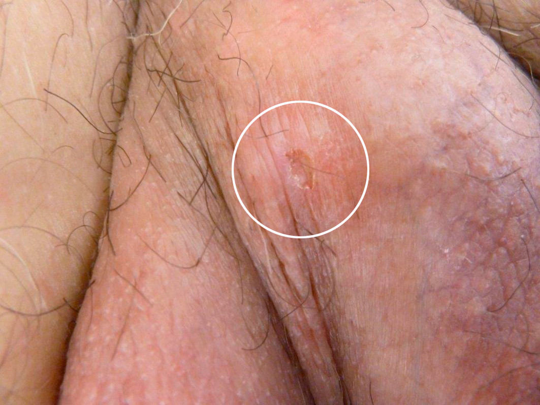 Fig 2 S&aring;r p&aring; scrotum (sirkel)