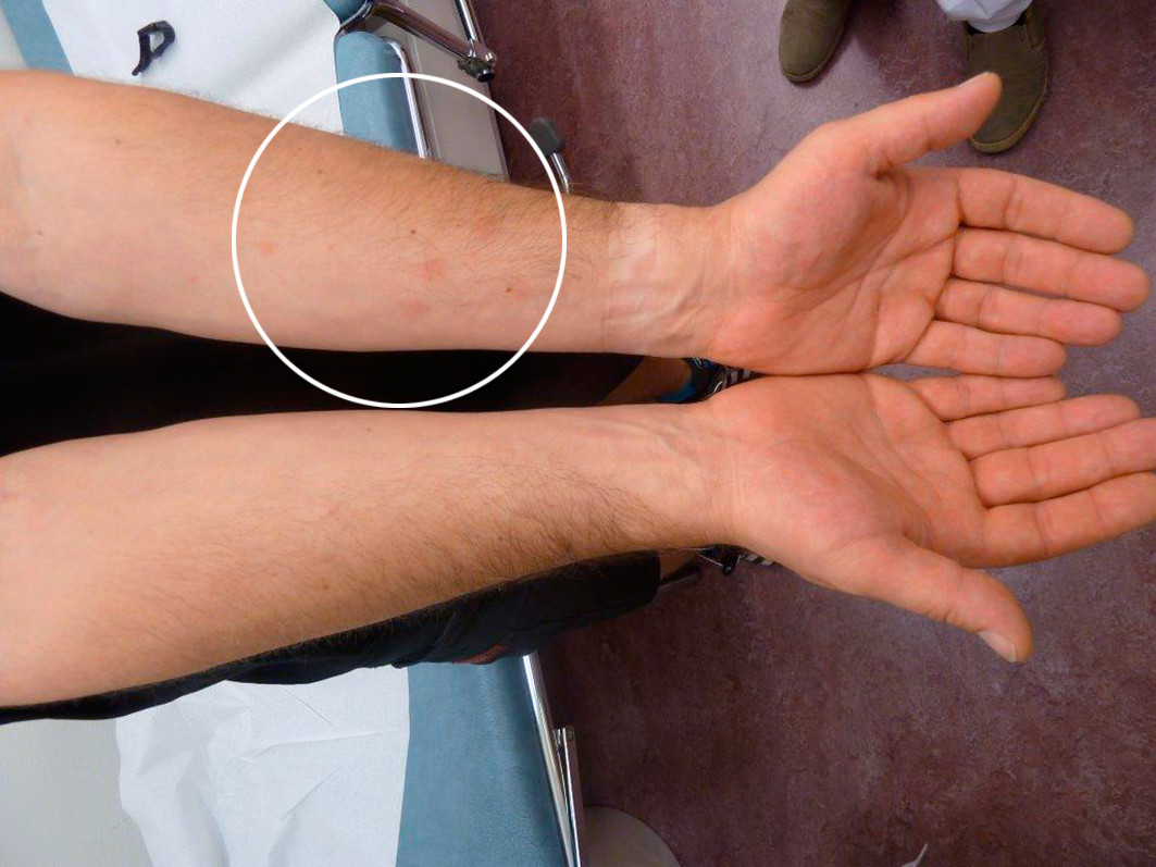 Fig 3 Makul&aelig;rt utslett p&aring; underarm (sirkel)