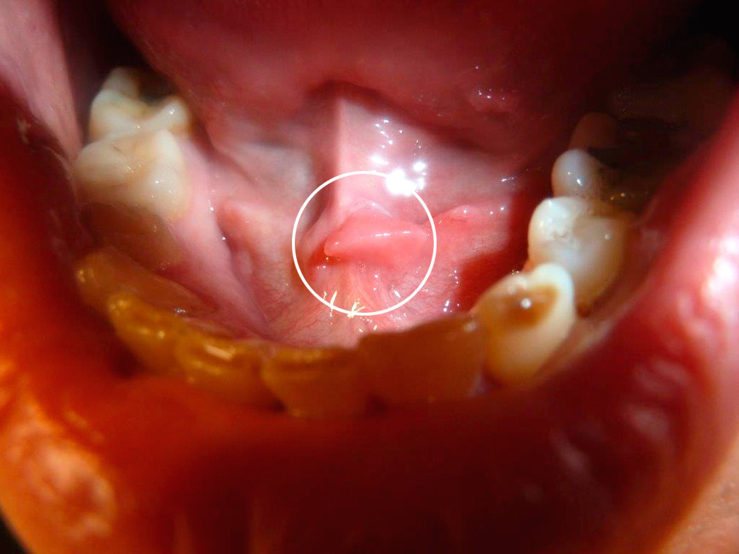 Fig 4 Hvitlig s&aring;rforandring under tungen med forst&oslash;rret karunkel (sirkel)