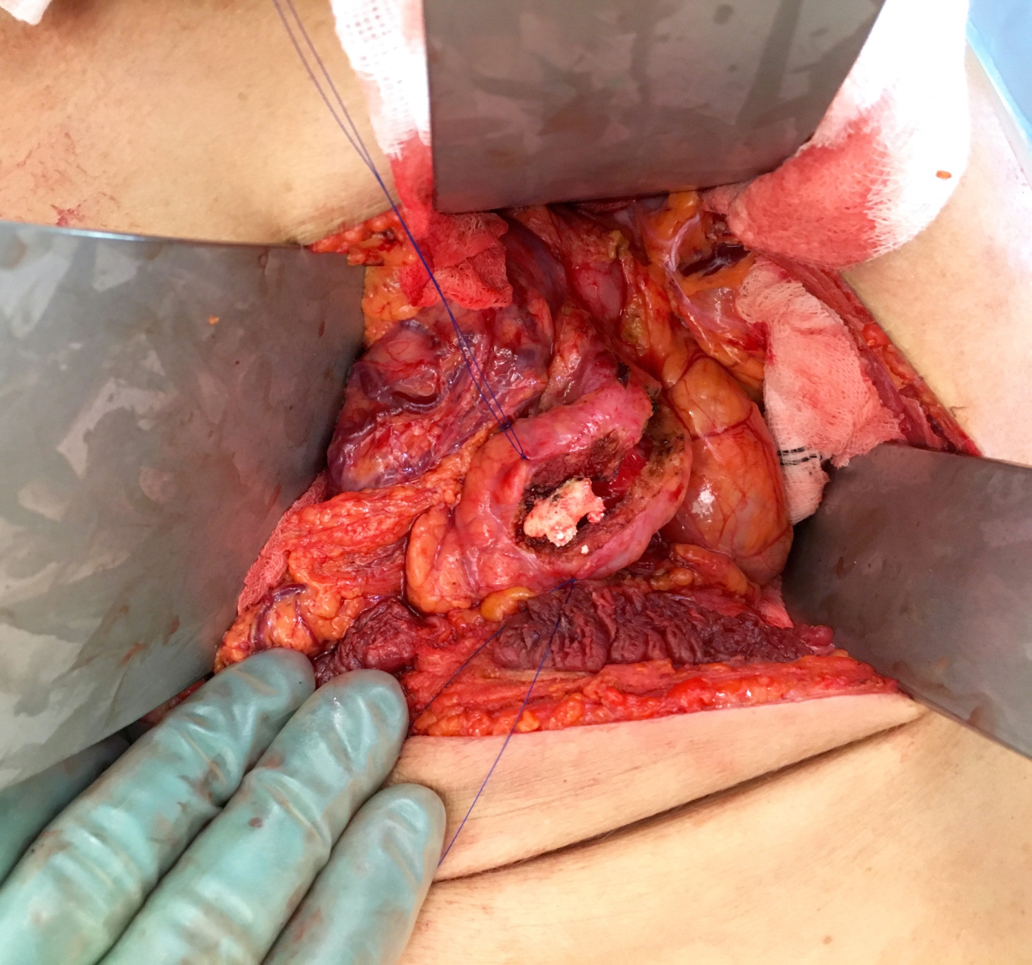 Figur 3 Pancreaskirurgi med okkluderende konkrement i en dilatert pancreasgang. Gangen er spaltet f&oslash;r anastomosering &hellip;