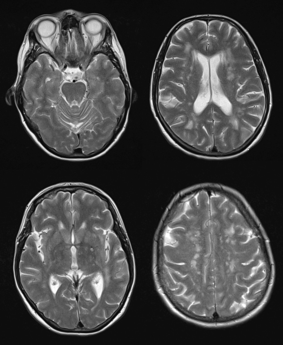 Figur 2 Aksiale T2-vektede bilder viser multiple, dels konfluerende uspesifikke hvitsubstanslesjoner periventrikul&aelig;rt og&hellip;