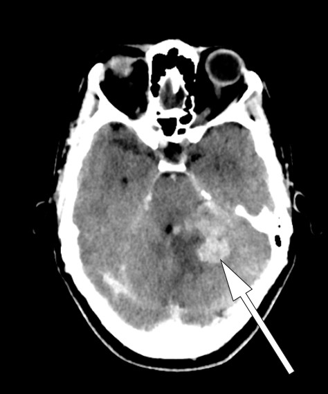 Figur 2 CT caput med kontrast (dag 6) viser kontrastladende lesjoner i venstre lillehjerneshemisf&aelig;re med omkringliggende &oslash;dem