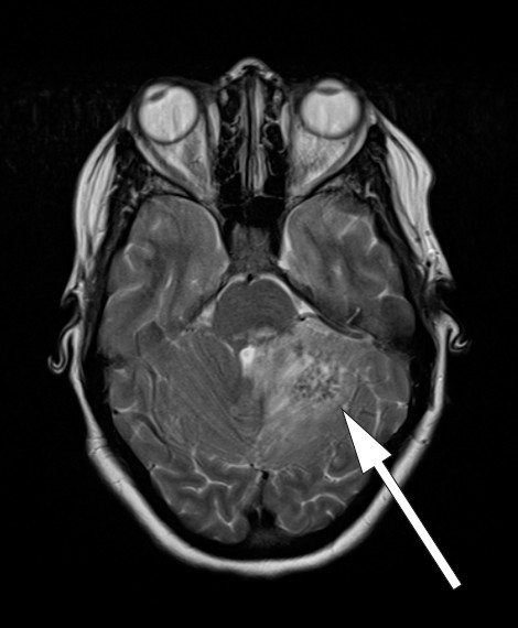 Figur 3 MR cerebrum med T2-vektet sekvens (dag 6) viser &oslash;dem med lavt signal sentralt i lesjonene som kan ses ved tuberkulom