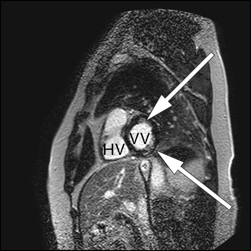 Figur 1 Magnetresonansbilde av hjertet med gadoliniumkontrast av pasient med myokardiell sarkoidose og normale&hellip;