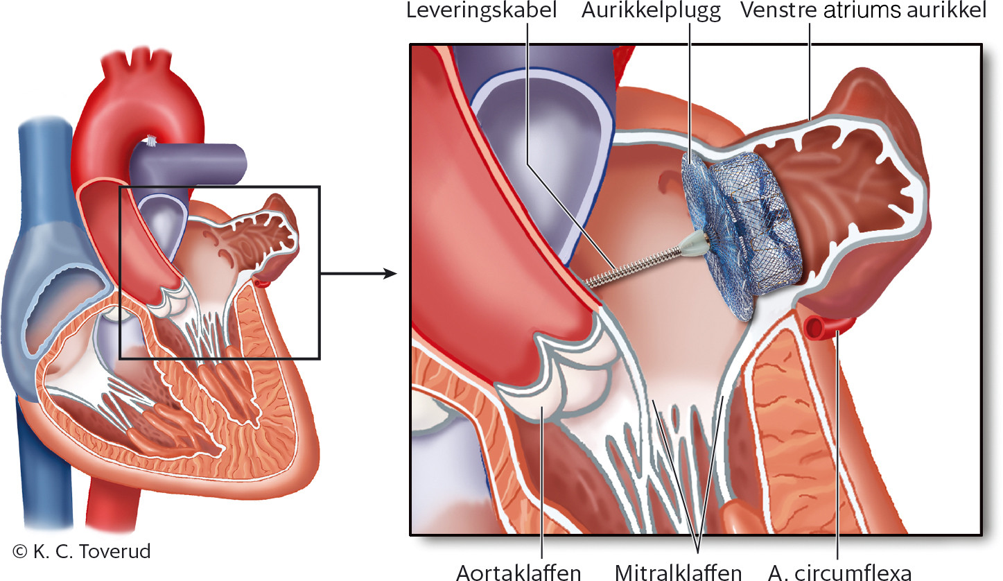 Figur 1 Til venstre et firkammerbilde av hjertet. Utsnittet til h&oslash;yre viser venstre atrium med aurikkelplugg p&aring; plass i&hellip;