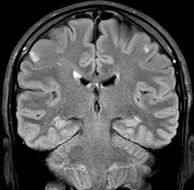 Figur 2 MR caput, koronal FLAIR. Sm&aring;, ferske infarktforandringer kortikalt i venstre frontallapp. Sekvele etter tidligere&hellip;