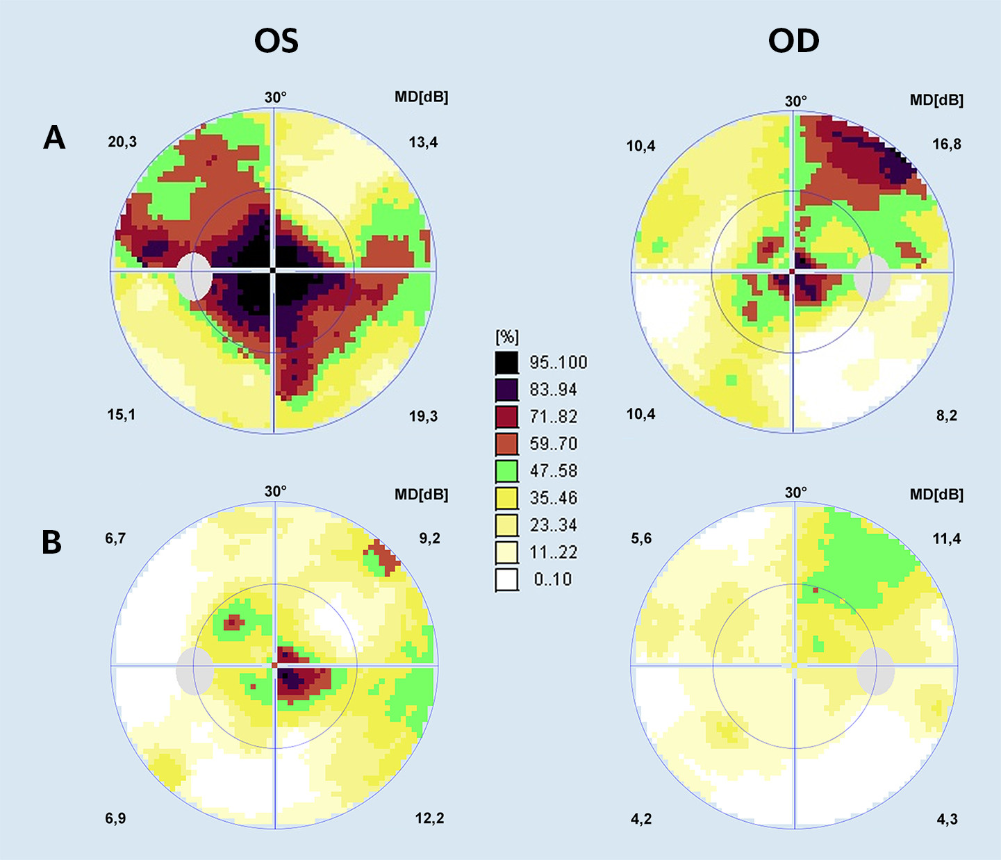 Figur 1 Terskelperimetri av sentrale 30 graders synsfelt p&aring; h&oslash;yre (OD) og venstre (OS) &oslash;ye i akutt fase (a) og etter&hellip;