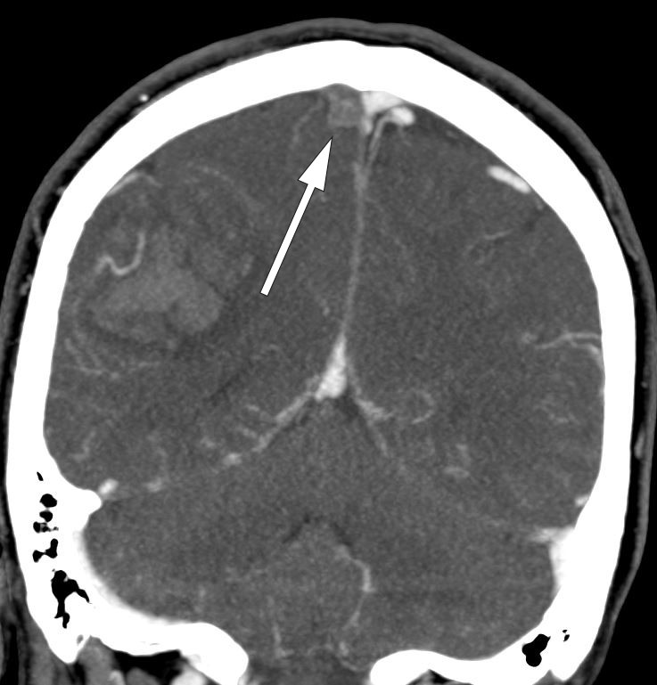 Figur 2 CT angiografi med ven&oslash;s fase som viser kontrastdefekt i h&oslash;yre sinus sagittalis superior, forenlig med ikke&hellip;