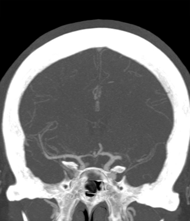 Figur 1 Koronalt snitt av CT-angiografi viste trombe proksimalt i venstre arteria cerebri media