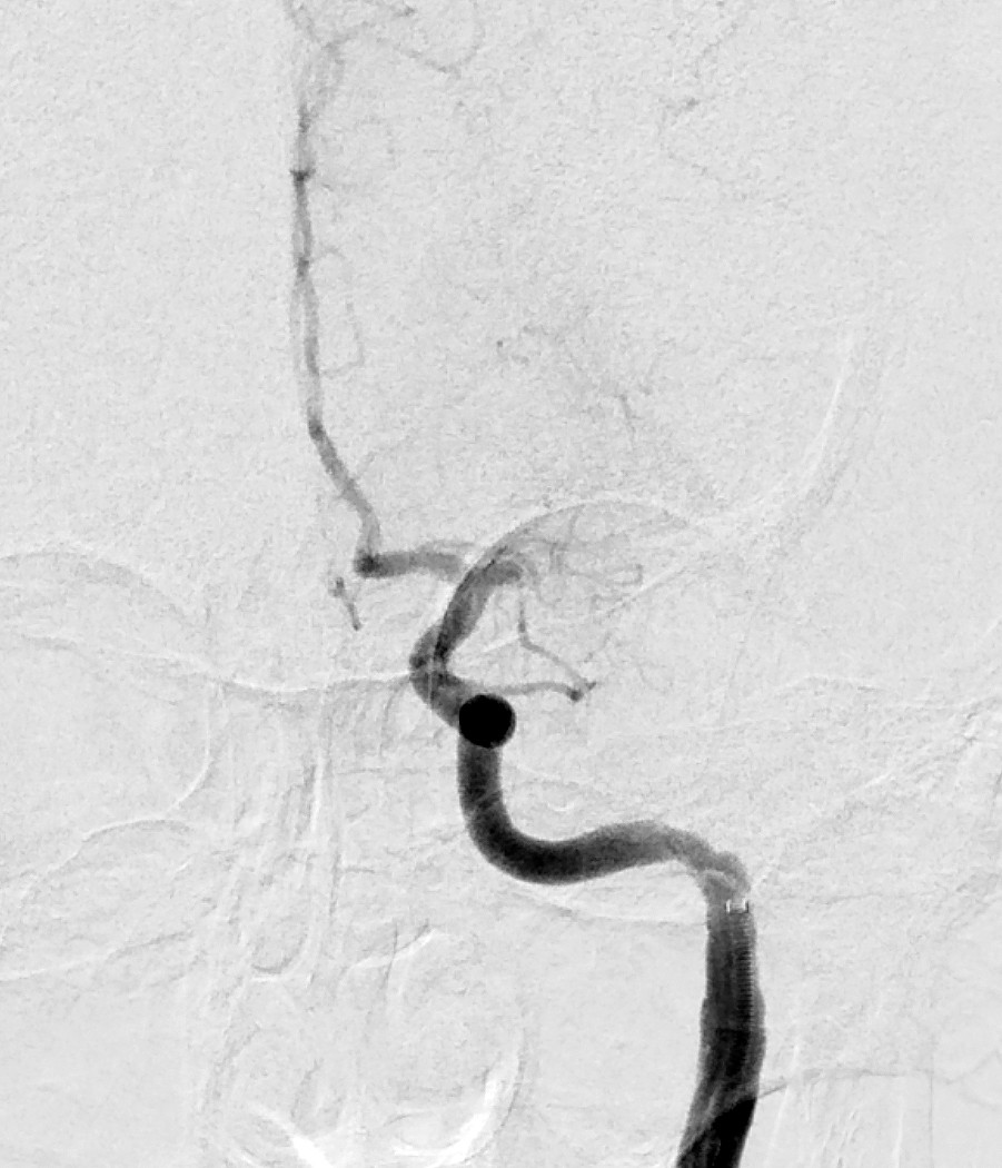 Figur 2 Invasiv angiografi bekreftet okklusjon