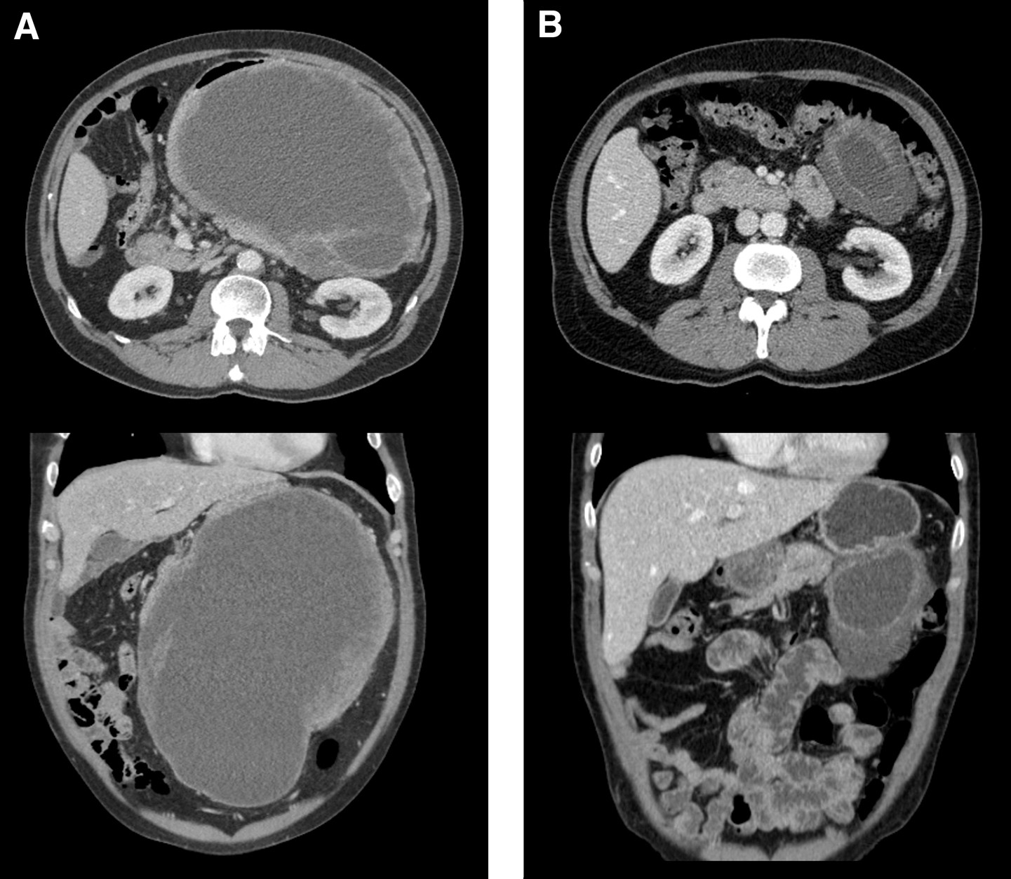 Figur 3 CT av abdomen og bekken hos en pasient med en stor gastrointestinal stromal tumor i ventrikkelen f&oslash;r preoperativ&hellip;