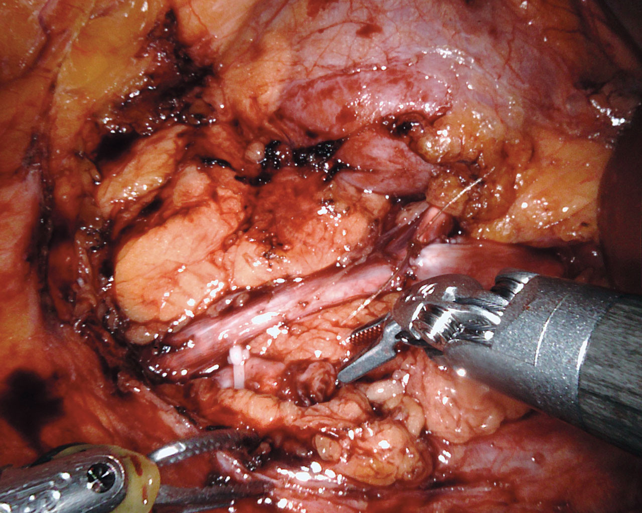 Figur 5 Anastomosen mellom &oslash;vre og nedre anlegg er ferdig.