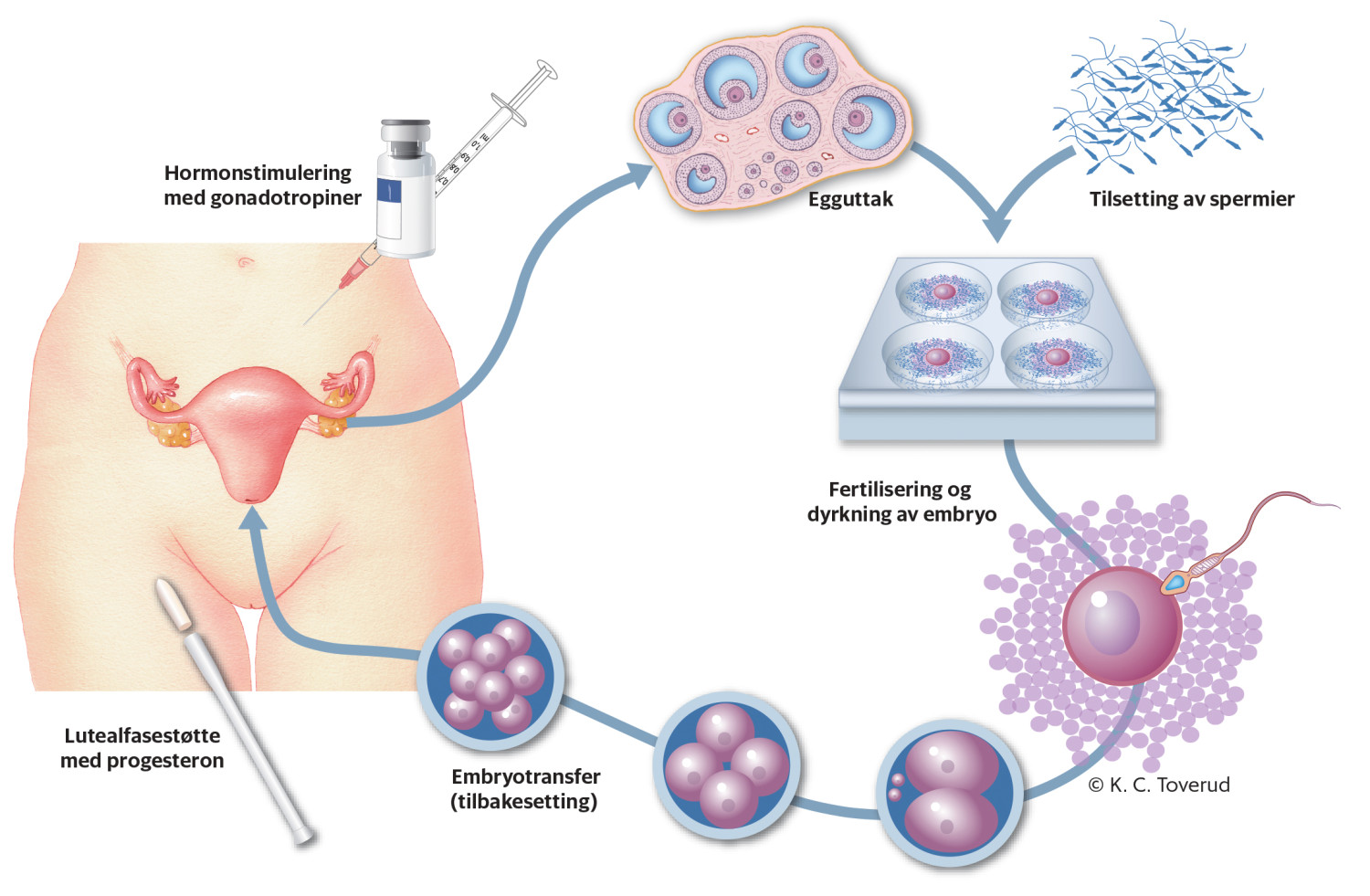 Figur 1 Fertilitetsbehandling med in vitro-fertilisering.