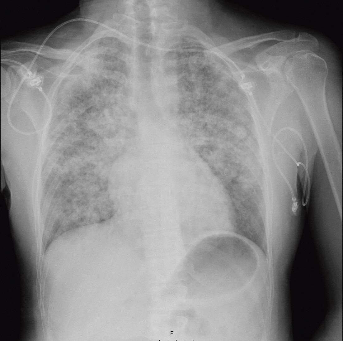 Figur 1 R&oslash;ntgen thorax tatt postoperativt viser utbredte fortetninger i begge lunger, forenlig med akutt lunge&oslash;dem.
