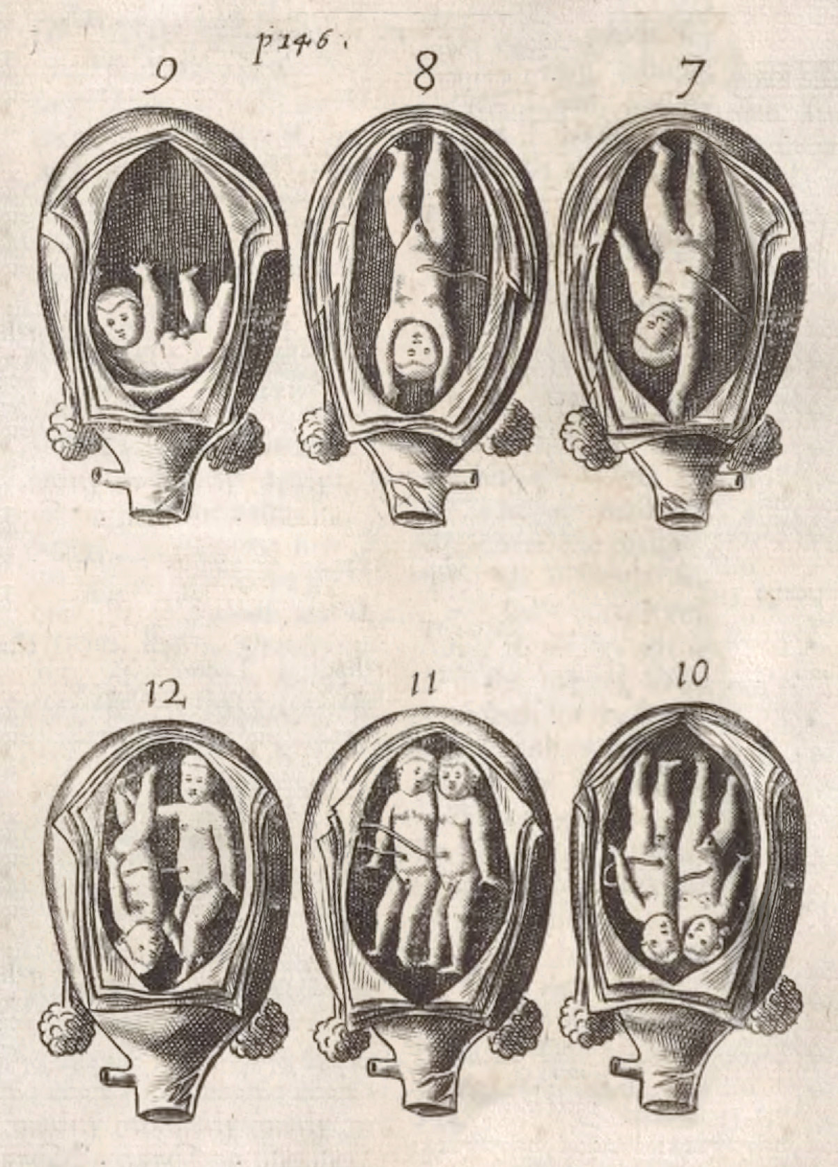 Figur 2 Tvillinger in utero i Thomas Chamberlaynes bok for jordm&oslash;dre, The Compleat Midwife's Practice Enlarged fra 1656&hellip;