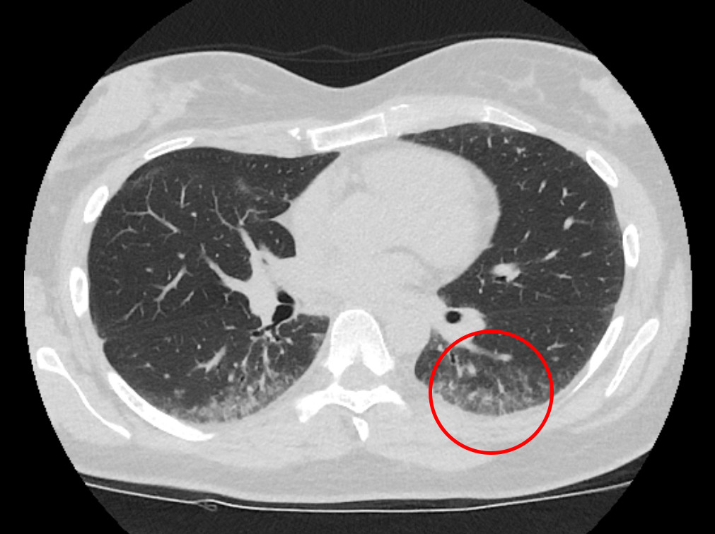 Figur 1 H&oslash;yoppl&oslash;snings-CT av thorax viser perifere subpleurale mikronodul&aelig;re lungefortetninger med innslag av&hellip;
