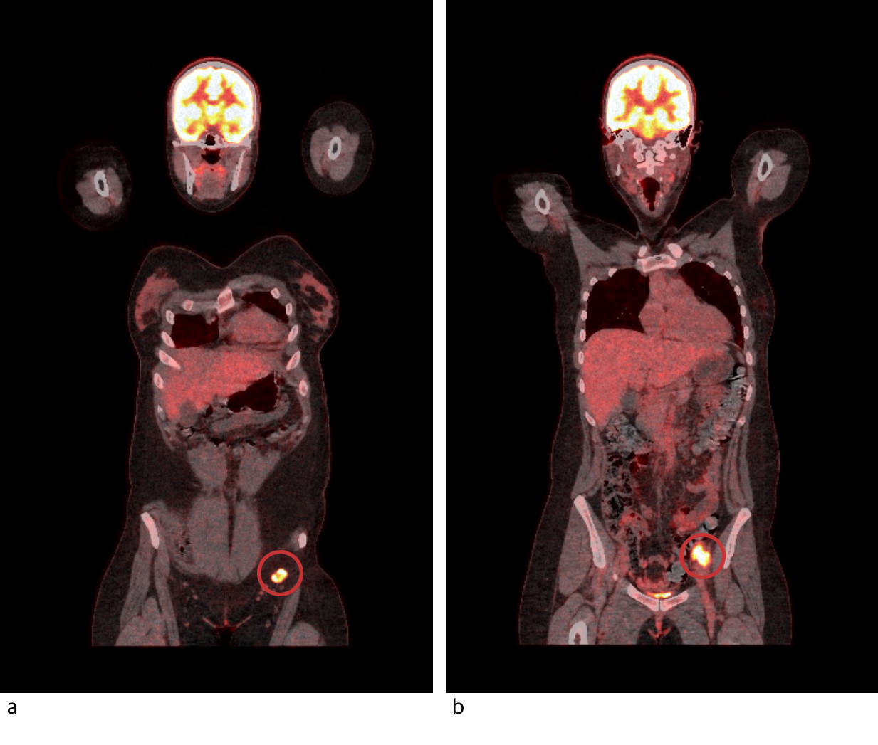 Figur 3 PET-CT viser h&oslash;yt opptak av 18F-fluorodeoksyglukose i patologisk forst&oslash;rrede lymfeknuter i venstre lyske (a) og&hellip;