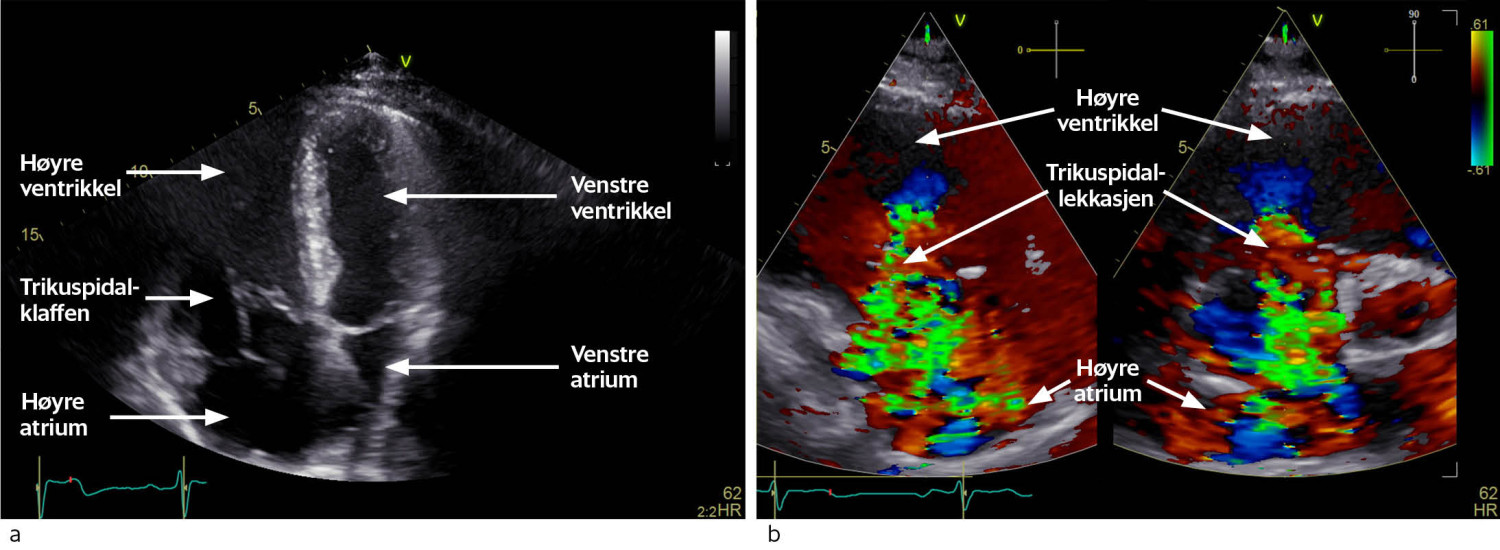 Figur 1 Ekkokardiografi. a) Apikalt 4-kammerbilde. Dilatert h&oslash;yre hjertehalvdel og prolaps av trikuspidalsegl. b)&hellip;