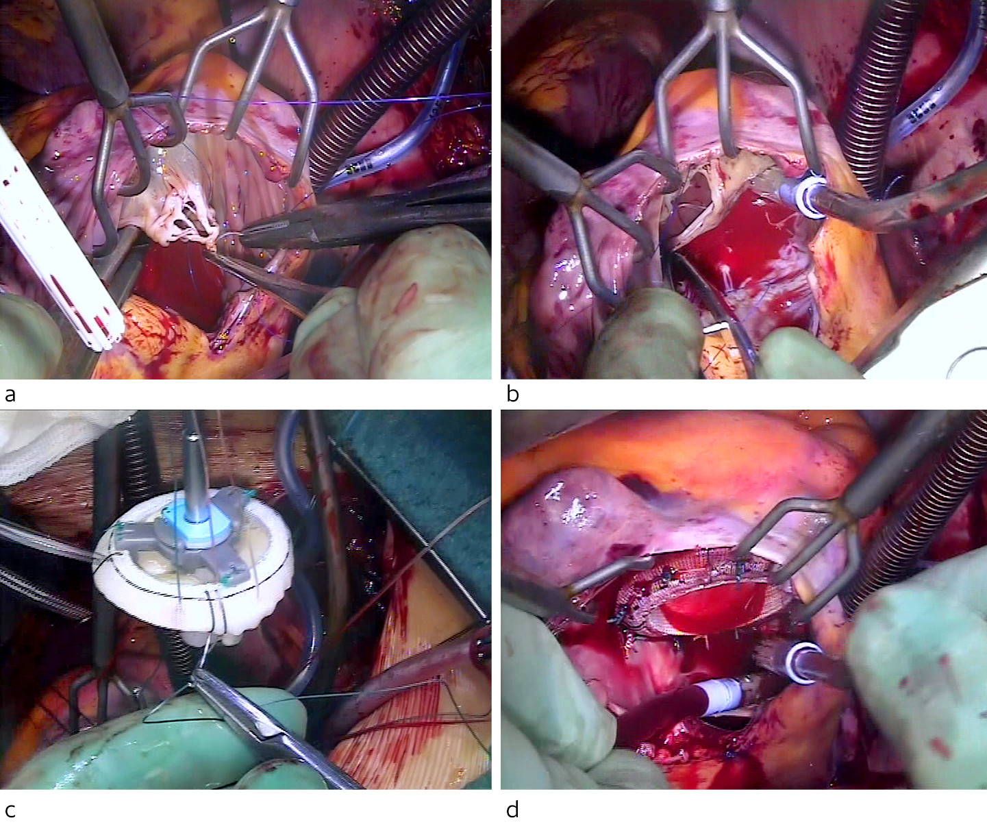 Figur 3 a) Trikuspidalklaffens anteriore seil med fibr&oslash;s rest som ble fors&oslash;kt reimplantert. b) Posteriore seil med elongert&hellip;