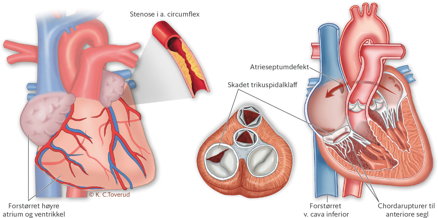 Figur 4 Fremstilling av pasientens ulike hjertefeil