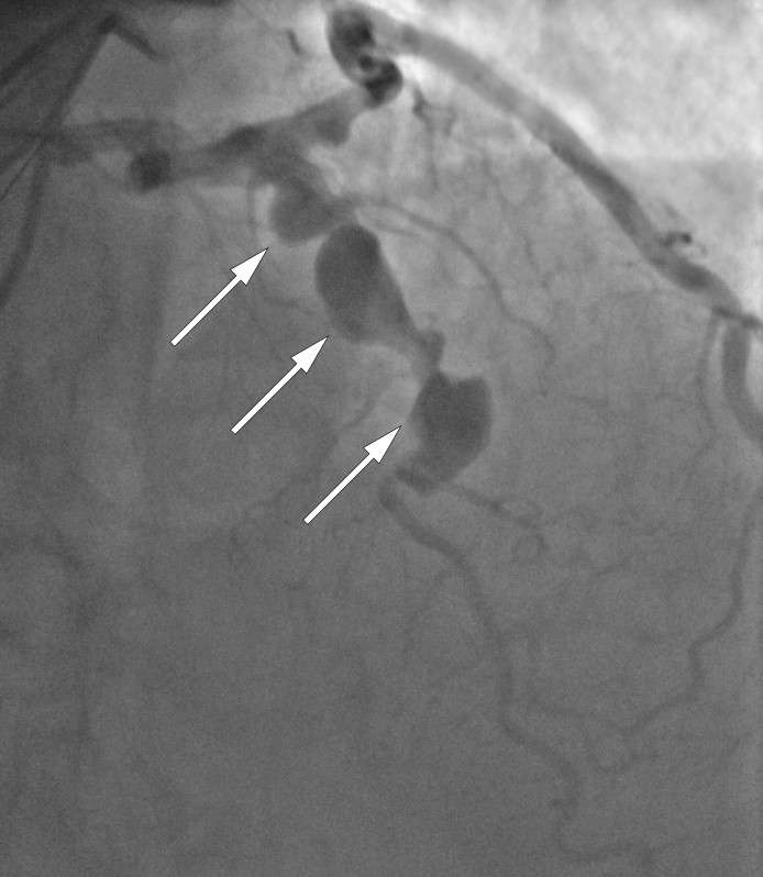 Figur 1 Koronarangiografi av venstre koronararterie. Det ses flere aneurismer i venstre fremre nedadstigende arterie (piler).
