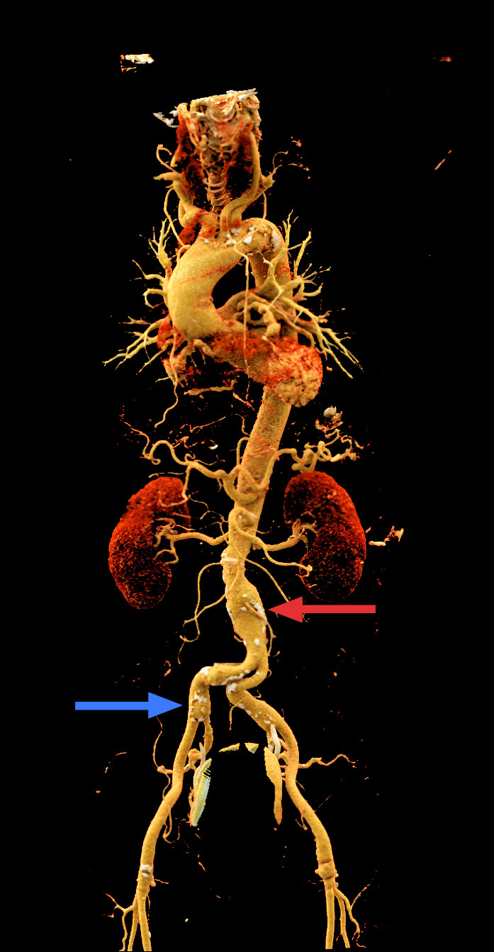Figur 2 Aorta med utposing infrarenalt med diameter 32 mm (r&oslash;d pil) samt ektasi av arteria iliaca communis bilateralt (bl&aring;&hellip;