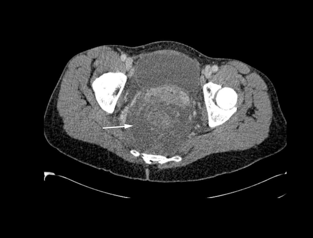 Figur 2 Transversalsnitt av CT abdomen/bekken, med stort mesorektalt &oslash;dem og diffust avgrenset rektumvegg (hvit pil).