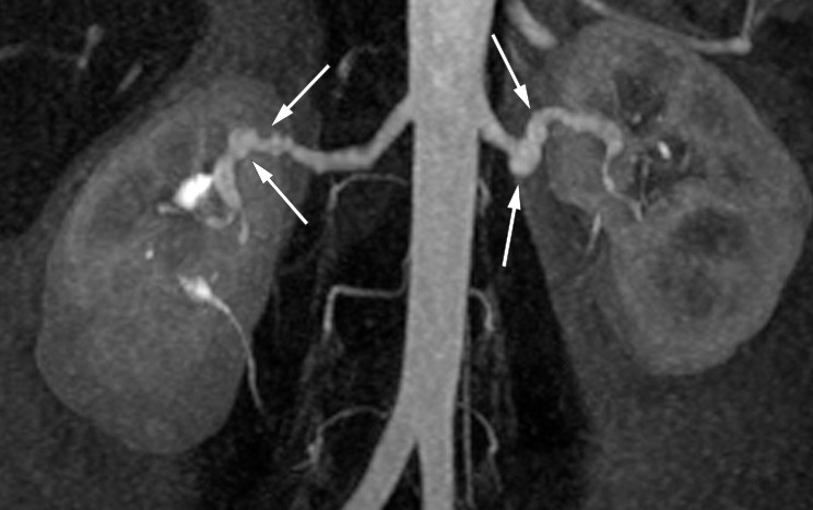 Figur 2 MR-angiografi av nyrearteriene hos en pasient. Bildet viser multifokal fibromuskul&aelig;r dysplasi der nyrearteriene har&hellip;