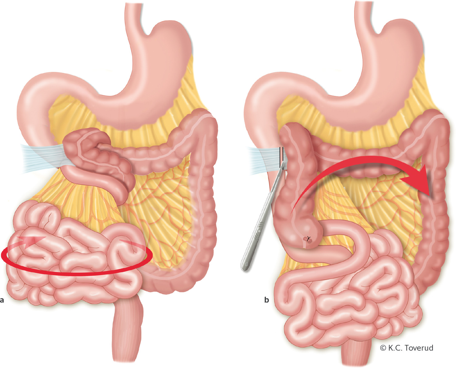 Figur 4  a) Midttarmsvolvulus p&aring; grunn av medf&oslash;dt malrotasjon, og duodenal obstruksjon p&aring; grunn av medf&oslash;dte Ladds b&aring;nd&hellip;