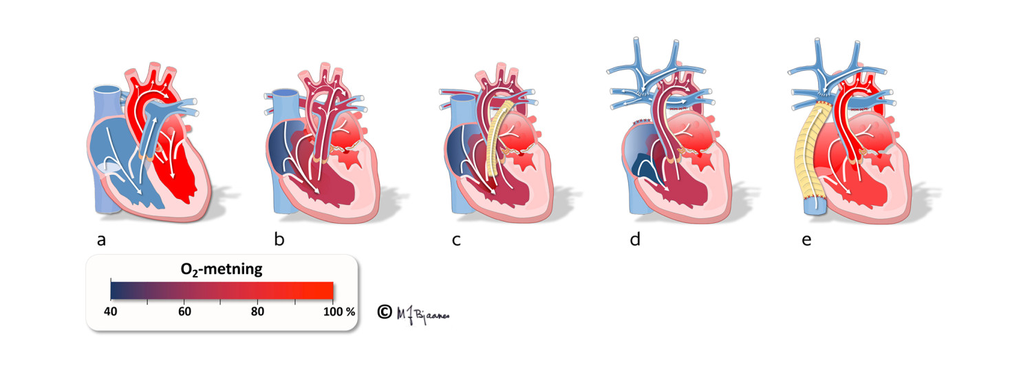 Figur 1 Normalt hjerte (a) og trinnvis kirurgisk palliasjon ved hypoplastisk venstre hjerte-syndrom (HVHS) (b&ndash;e). b)&hellip;