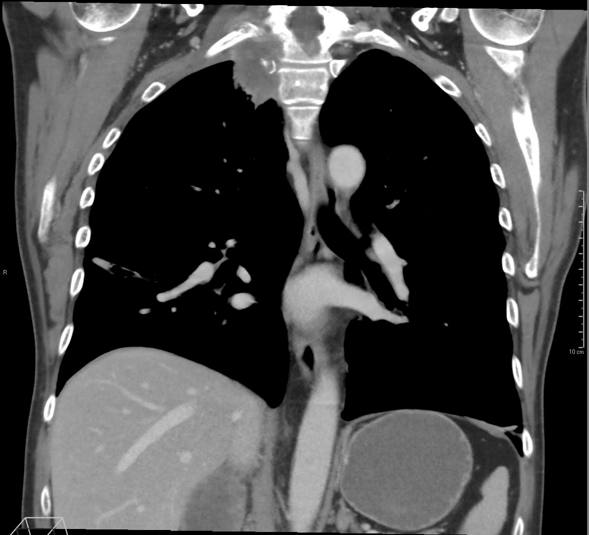 Figur 1 CT thorax i koronalplan viser tumor apikalt medialt i h&oslash;yre lungetopp med innvekst til torakalvegg og columna, og&hellip;