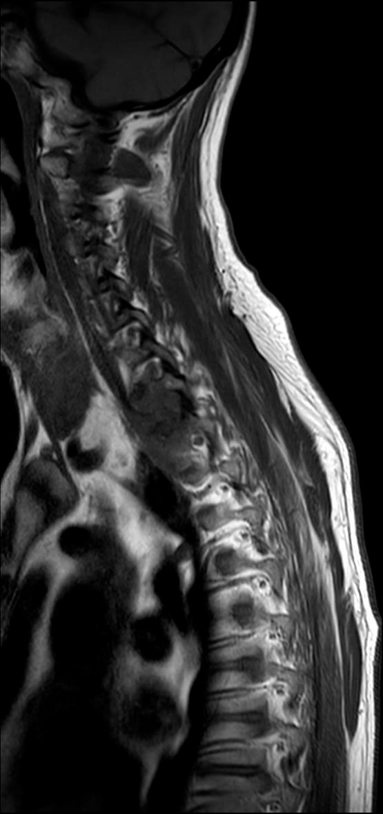 Figur 2 MR columna i sagittalplan (T1) viser tumor som vokser inn i nevroforaminae C7&ndash;Th3.