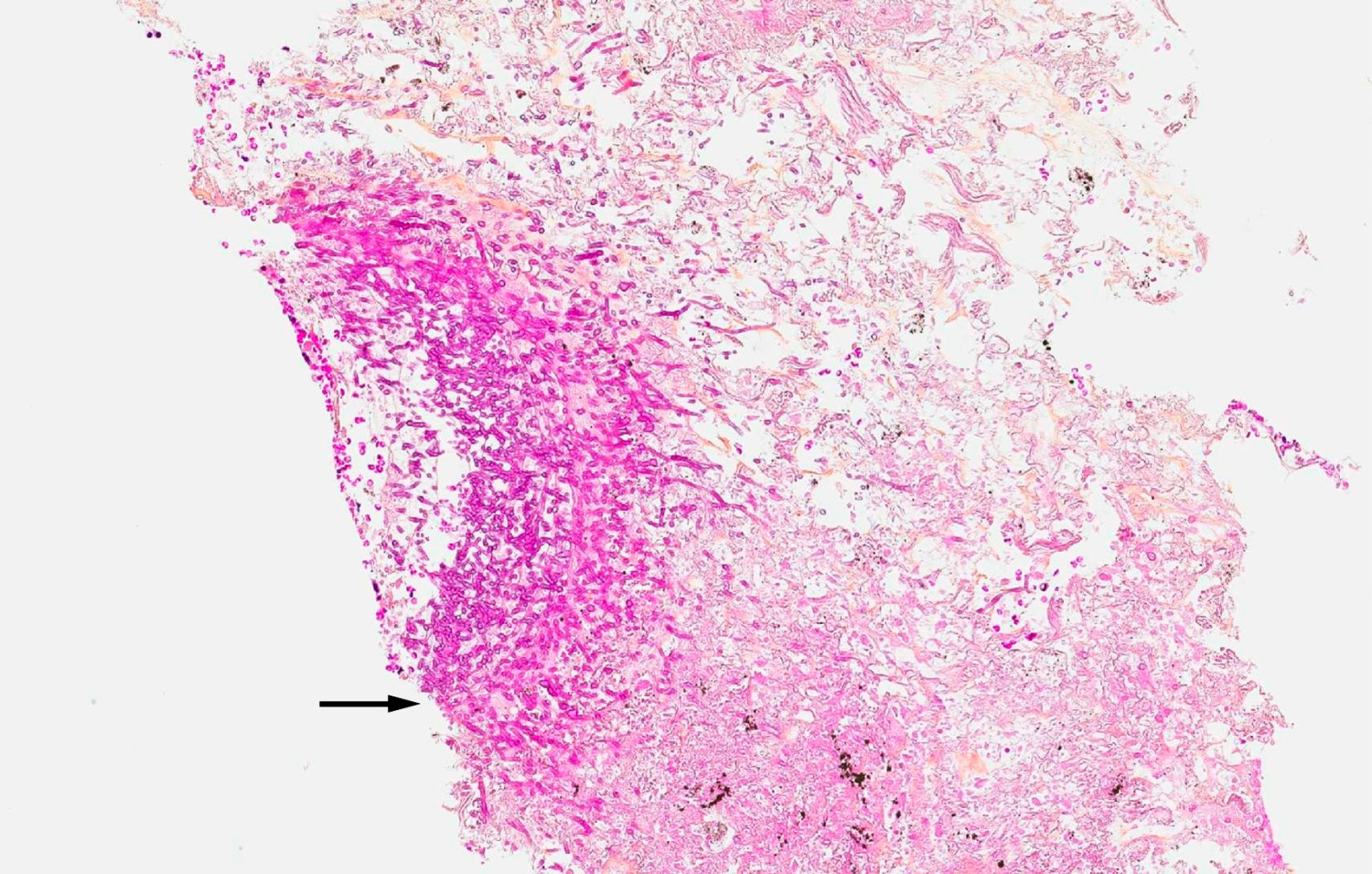 Figur 3 Histologisk bilde etter CT-veiledet biopsi fra lungetumor viser nekrose og infiltrasjon med Aspergillus-soppkolonier&hellip;