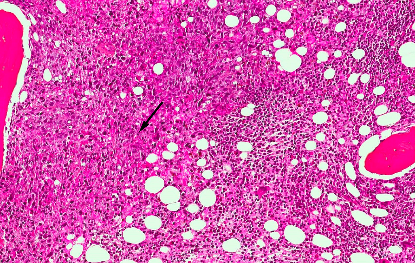 Figur 4 Histologisk bilde etter CT-veiledet biopsi fra lesjon i virvel L1 viser benvev med solid tumorkomponent. Man ser&hellip;